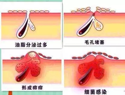 New&New|比春敏更痛苦的事...不要讓爆痘毀了你的臉！