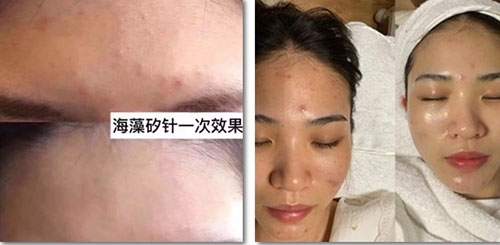 排出炎癥，治愈痘痘粉刺