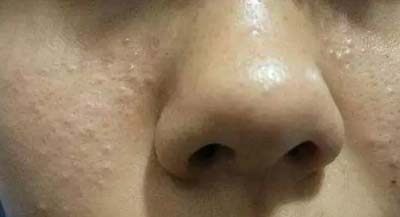 皮膚吸收不暢、粉刺痘痘不斷，是時候做下深層清潔了