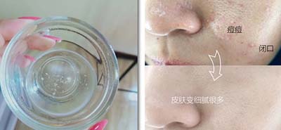 皮膚吸收不暢、粉刺痘痘不斷，是時候做下深層清潔了