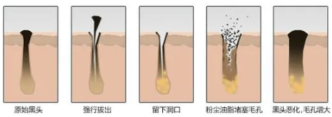 如何去黑頭？為什么要定期做去黑頭管理？VN給你好的答案